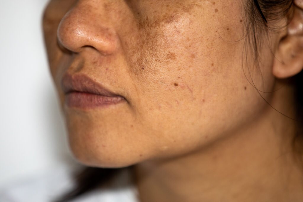 Pigmentation And Melasma