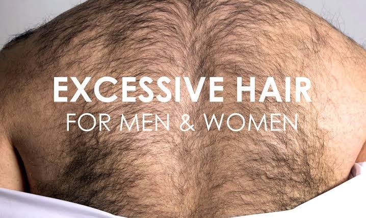 Excess Body and Facial Hair