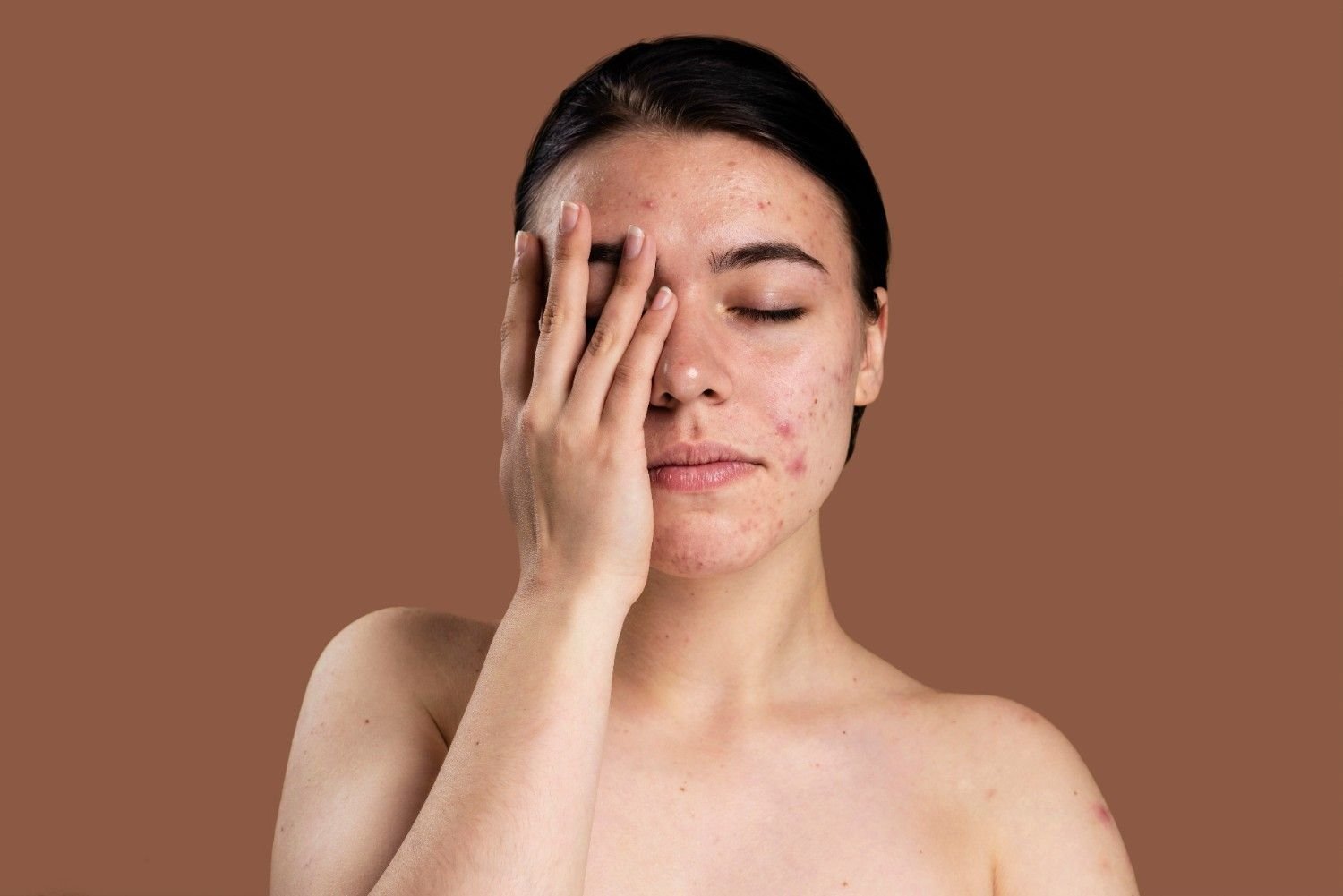 Acne and Acne Scar