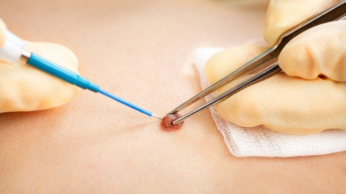 Mole & Wart Removal