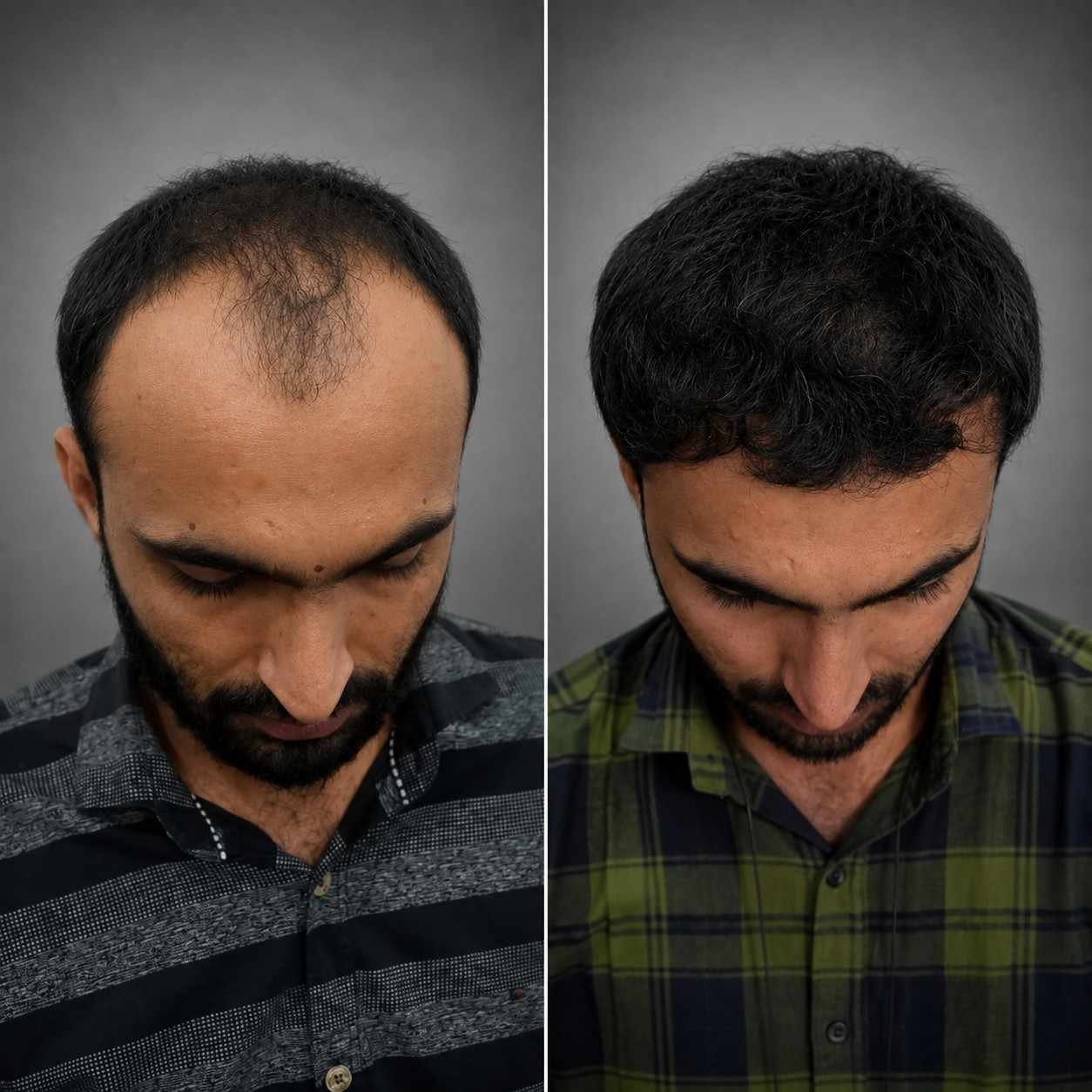 Grade 4 | 3620 Grafts | FUE  - After 6 Months