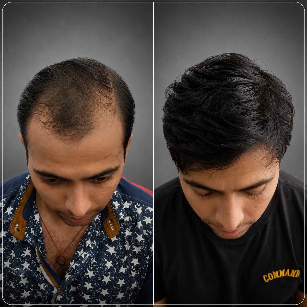 Grade 3 | 3400 Grafts | FUE - After 9 Months